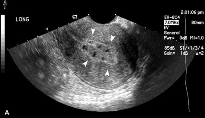 Hysterosonography Ultrasound (Sonohysterography)