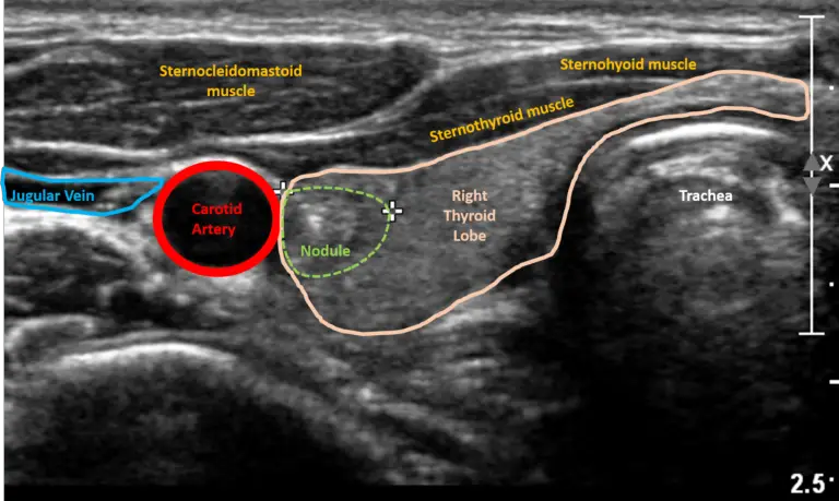 thyroid-ultrasound-purpose-and-procedure-healthtian