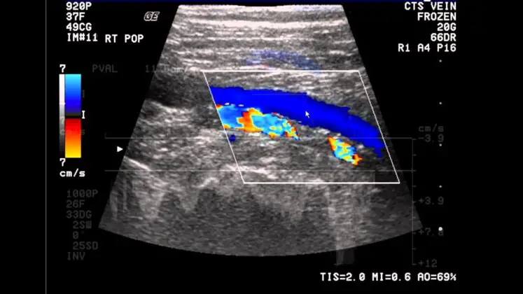 Venous Ultrasound Everything You Need To Know Healthtian 8072