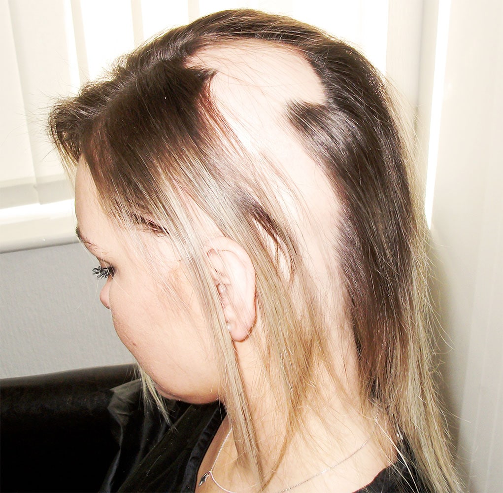 Alopecia Areata in women