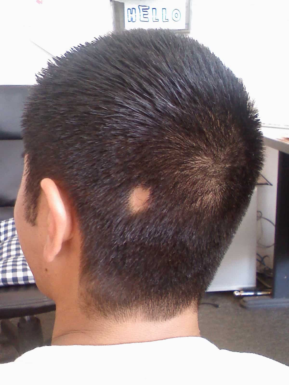 Alopecia Areata in men