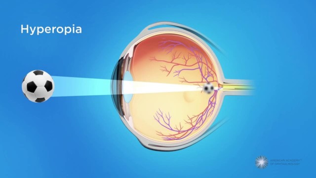 Hyperopia (Farsightedness): Symptoms, Causes, Diagnosis And Treatment ...