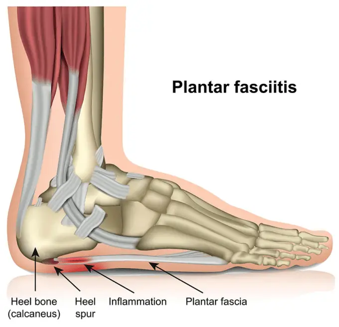 Plantar Fasciitis (Policeman’s Heel): Causes, Symptoms and Treatments ...