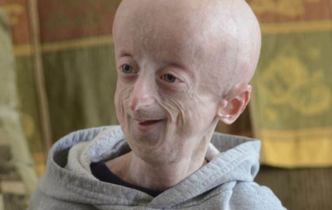 Progeria Syndrome