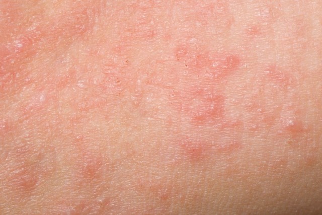 Scabies Symptoms And Causes Healthtian