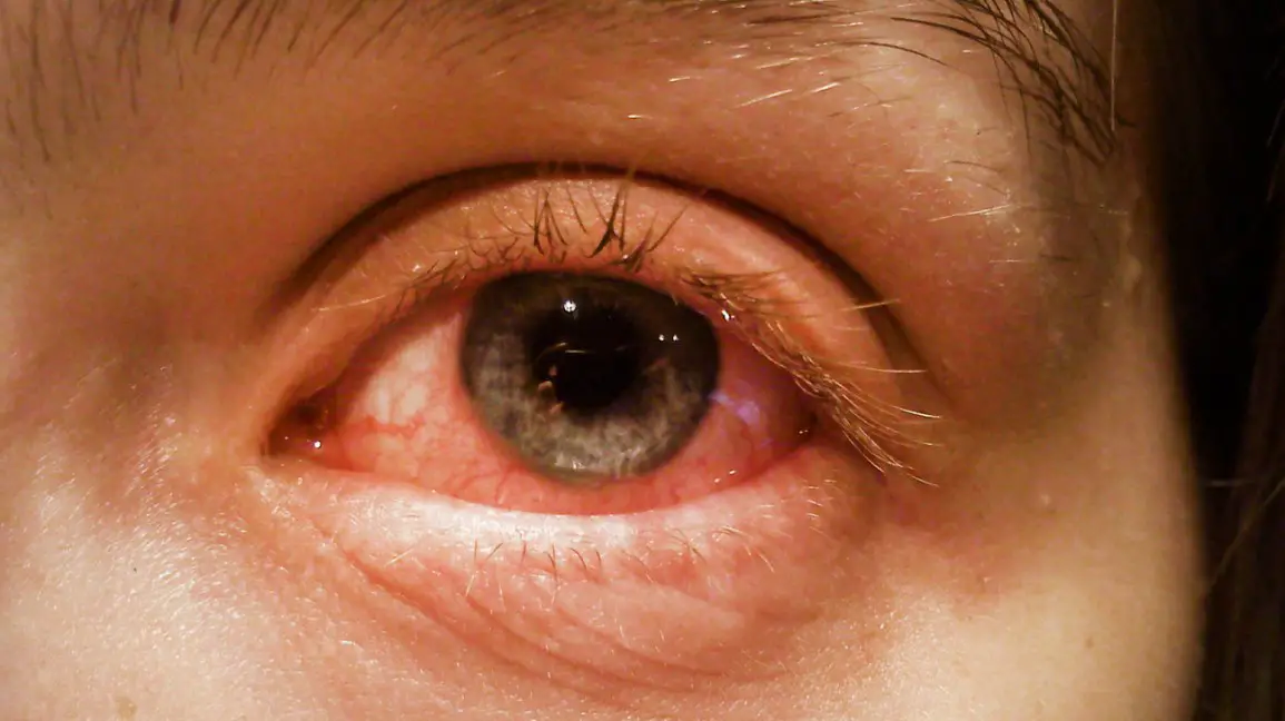 Conjunctivitis (Pink Eye)