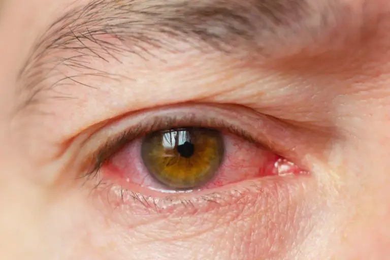 Conjunctivitis (Pink Eye): Causes, Symptoms, Prevention And Treatment ...