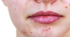 Acne During Pregnancy