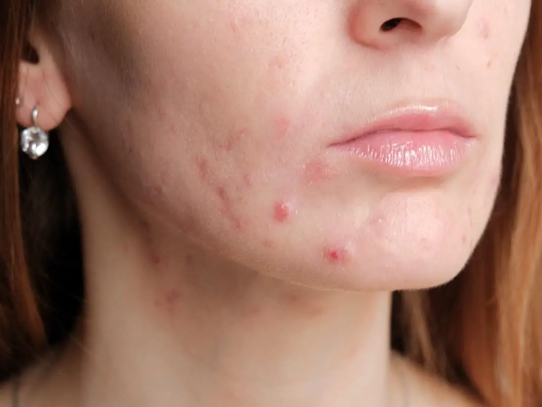 Acne During Pregnancy