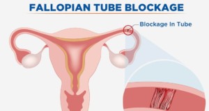 Blocked Fallopian Tube