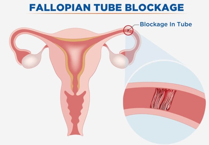 Blocked Fallopian Tube
