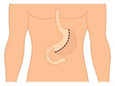 Gastrectomy