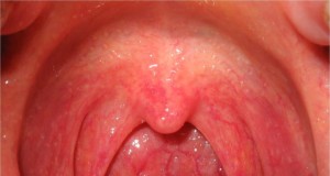 Strep throat streptococcal pharyngitis