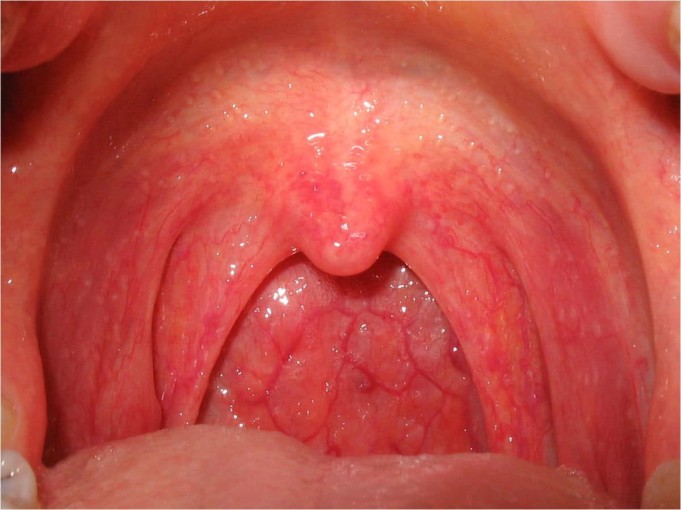 Strep throat streptococcal pharyngitis