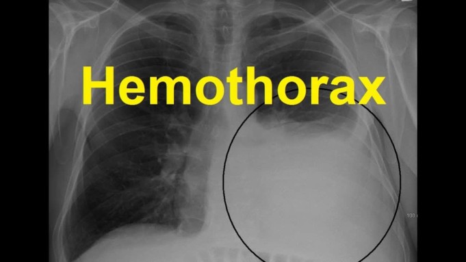 Hemothorax