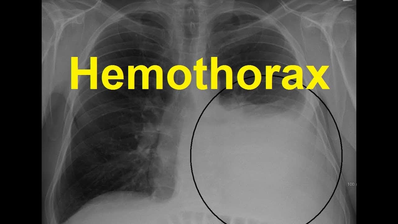 hemothorax lung sounds