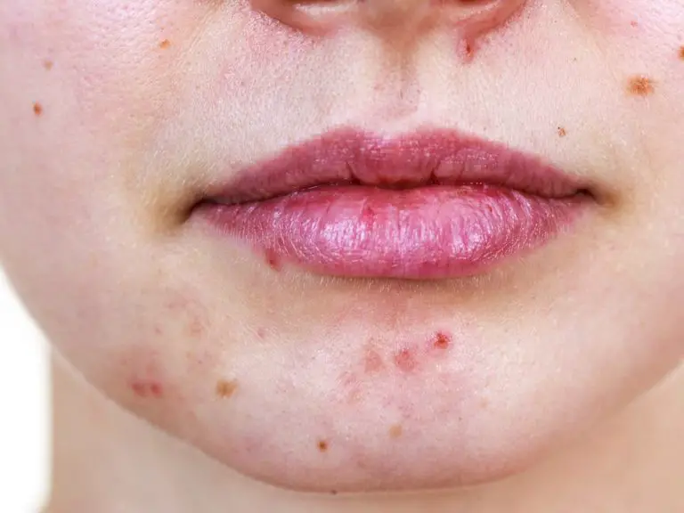 How To Treat And Prevent Acne During Pregnancy