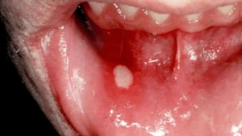 Aphthous Ulcers