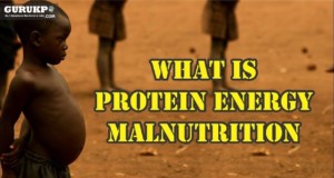 Protein-energy Malnutrition