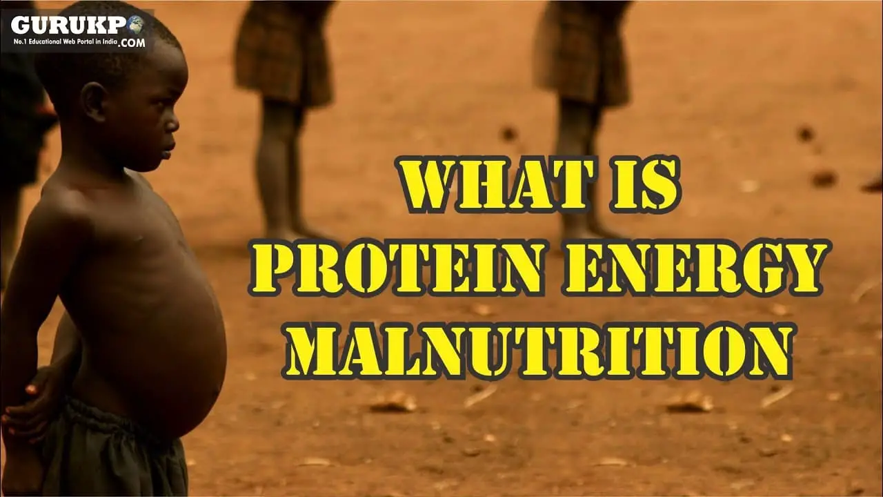 an essay on protein energy malnutrition