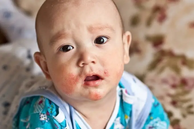 Rosacea in Toddlers