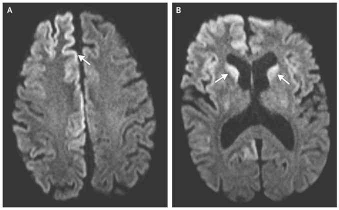 creutzfeldt-jakob-disease-causes-and-symptoms