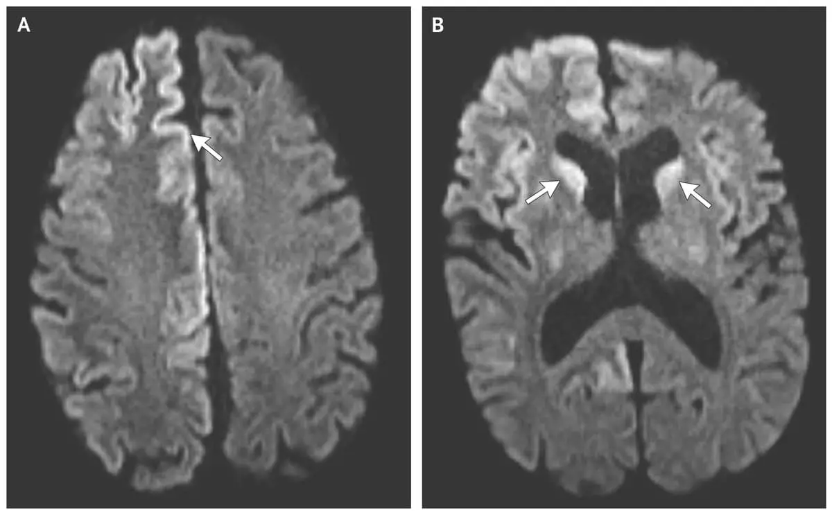 Creutzfeldt-jakob Disease: Causes and Symptoms