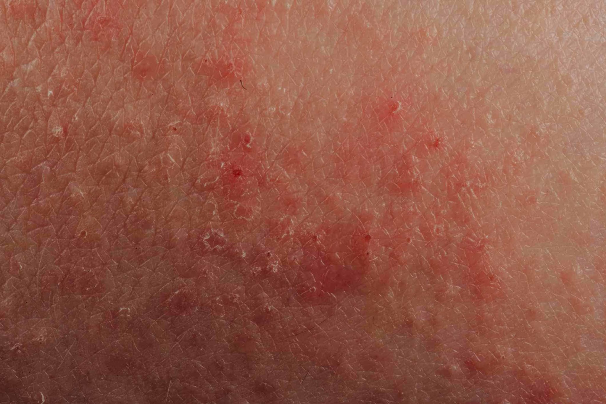 Skin Problems Sensitivity Eczema Acne Rosacea And Your Gut