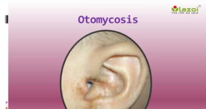 Otomycosis