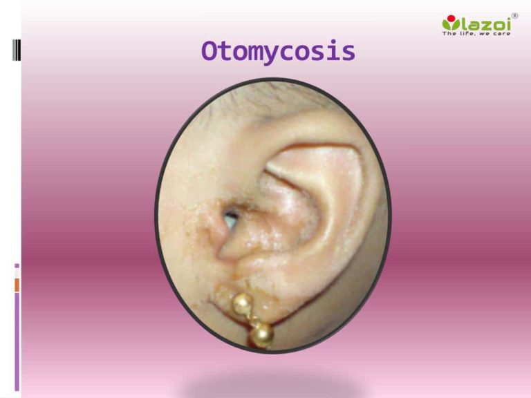 Otomycosis: Causes And Symptoms | Healthtian