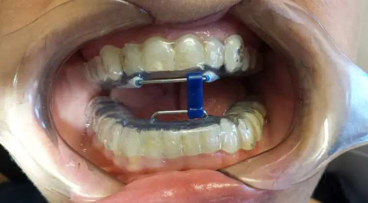 Mandibular Advancement Device: Everything You Need to Know | Healthtian