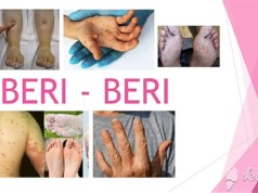 Beriberi (Thiamine Deficiency)