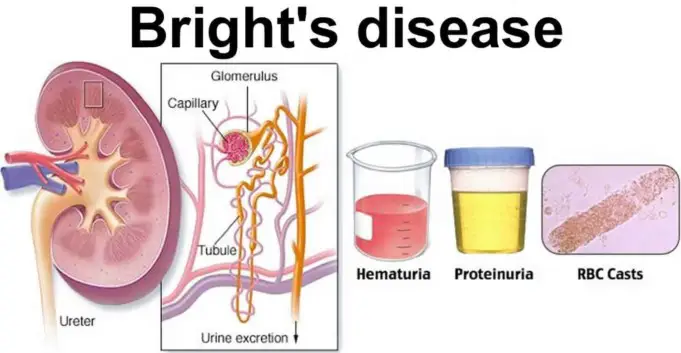 Bright Disease