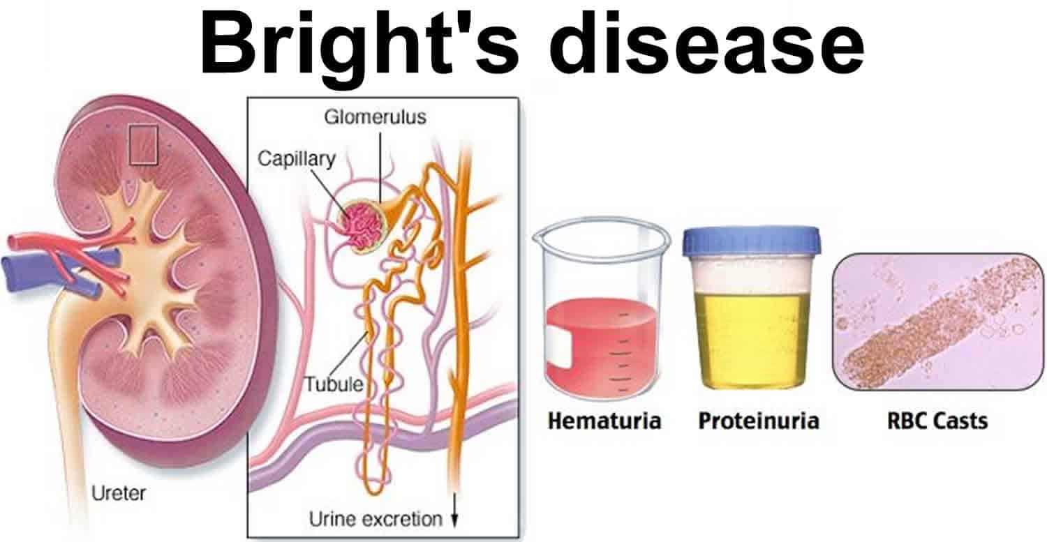 what-is-bright-disease