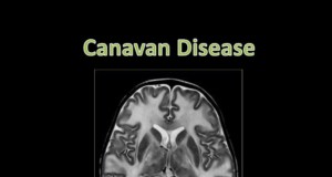 Canavan Disease