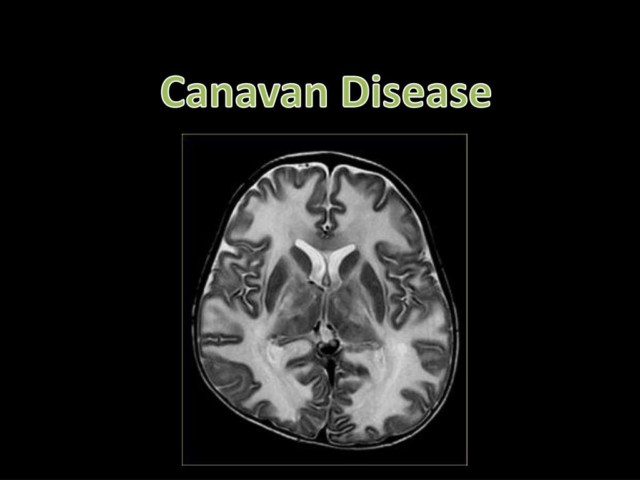 Canavan Disease: Symptoms, Causes and Treatment