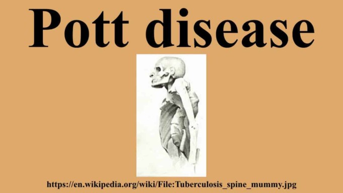 Pott Disease