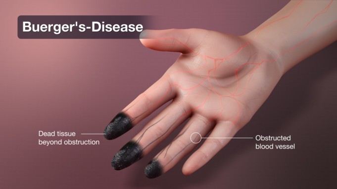 Buerger’s Disease