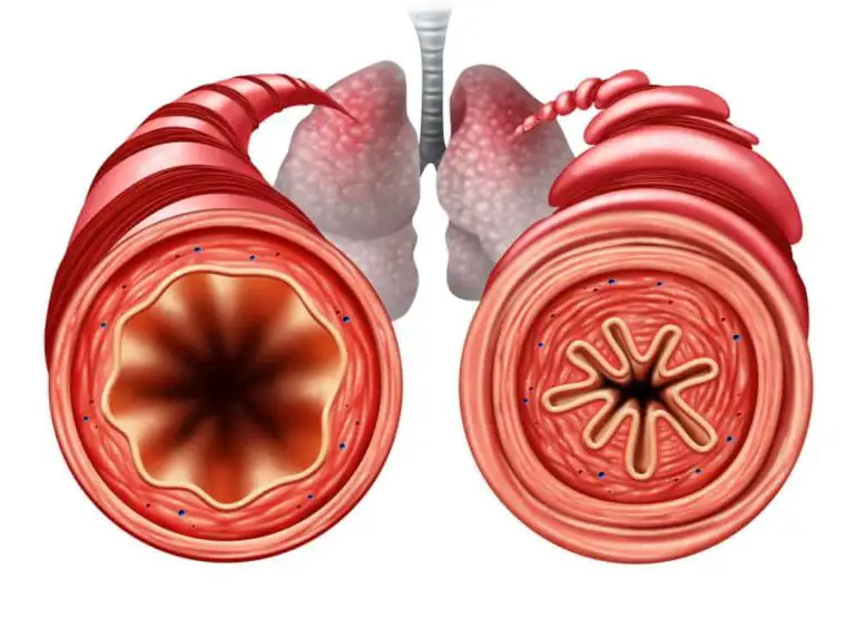 Reactive Airway Disease Vs Bronchitis