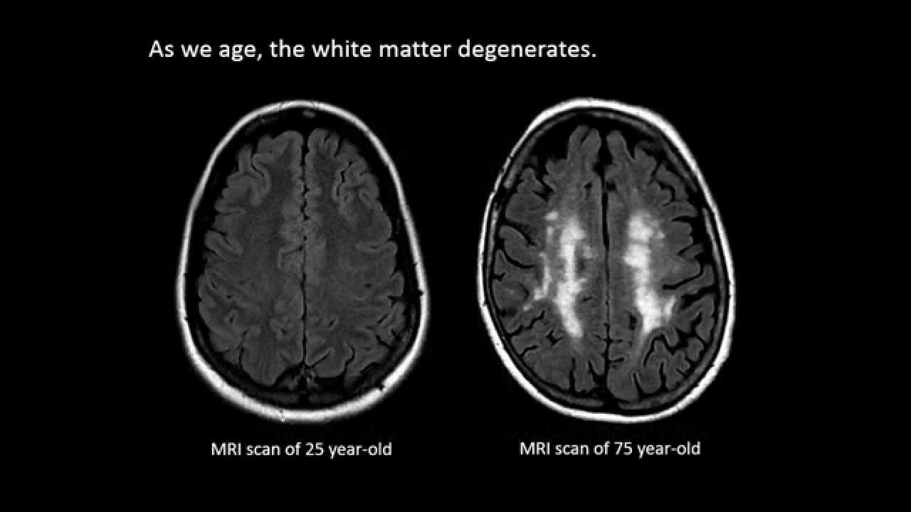 What Is White Matter Disease Healthtian   White Matter Disease 