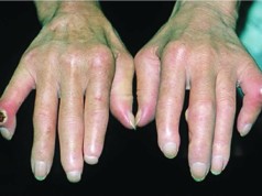 Scleroderma (Crest Syndrome)