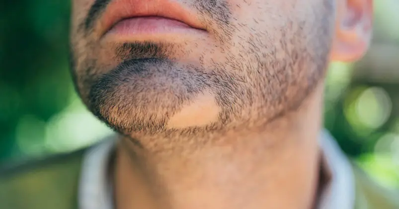 What Causes Facial Hair Loss