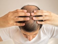 Men’s hair loss