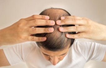Men’s hair loss