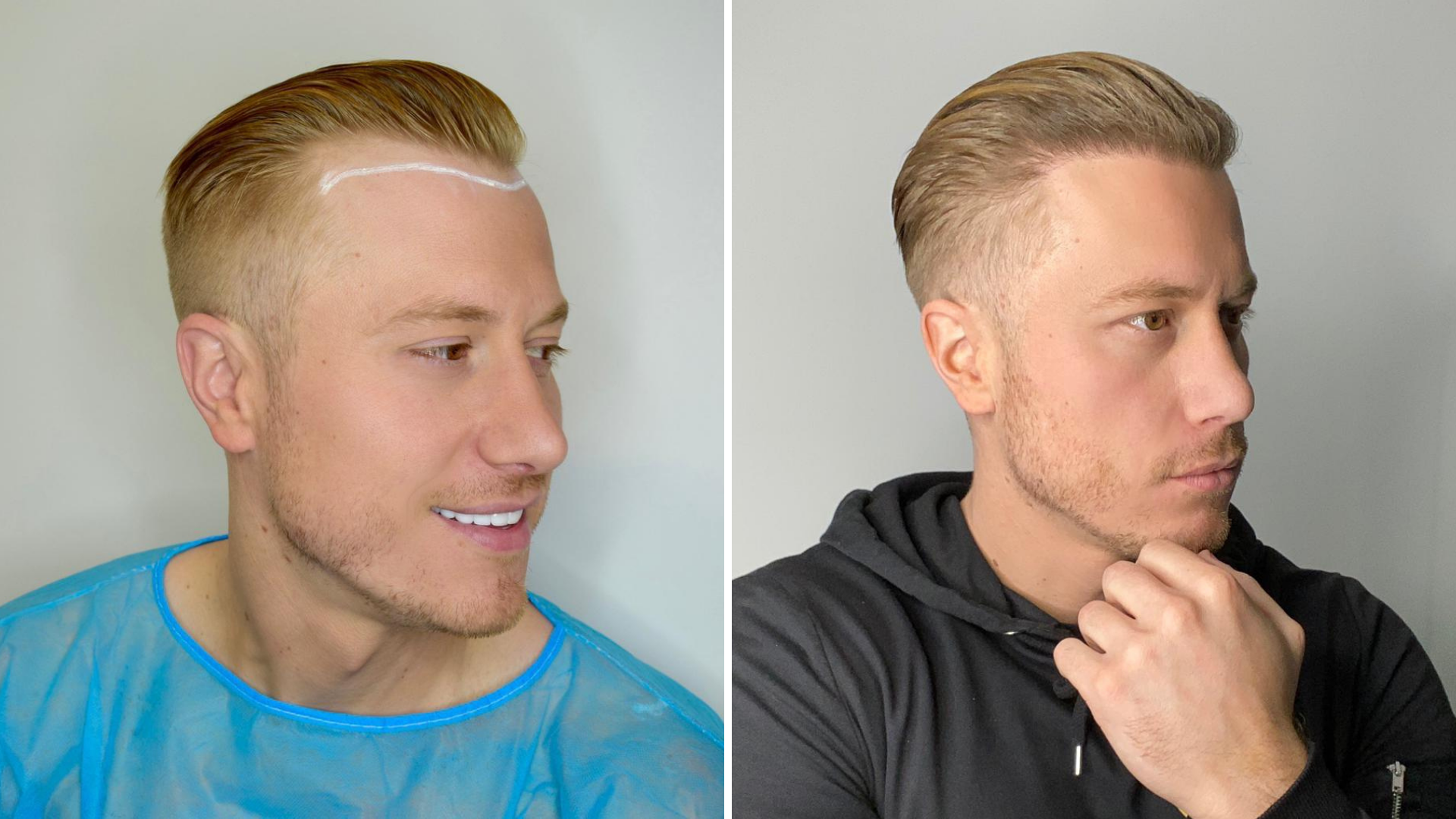 Is It Safe To Go Abroad For a Hair Transplant? | Healthtian