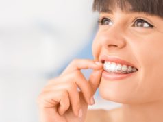 Impress clear aligners