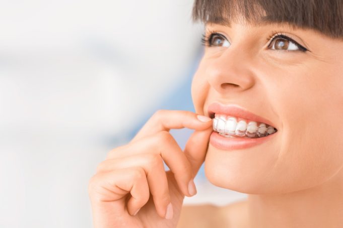 Impress clear aligners