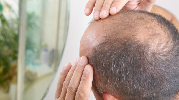 Help Recover from Hair Loss